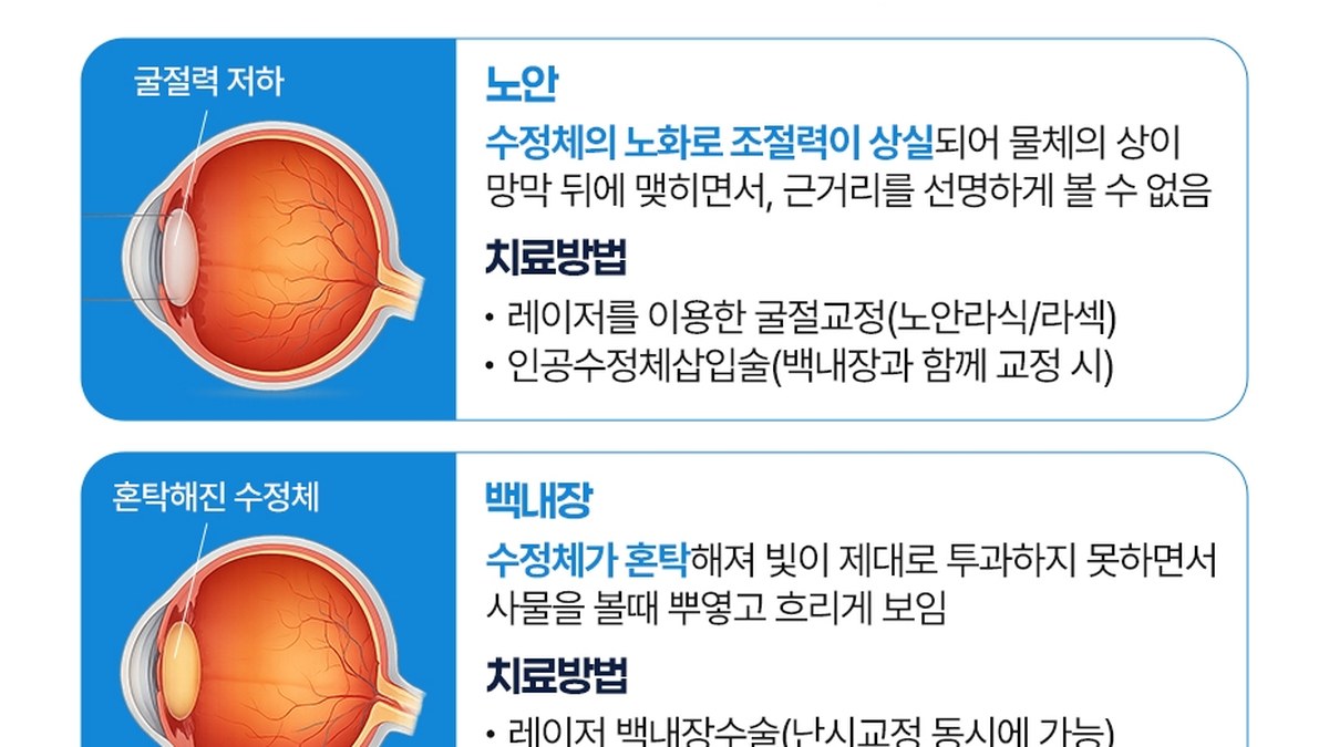 안구 단면 그림으로 노안과 백내장을 비교한 표