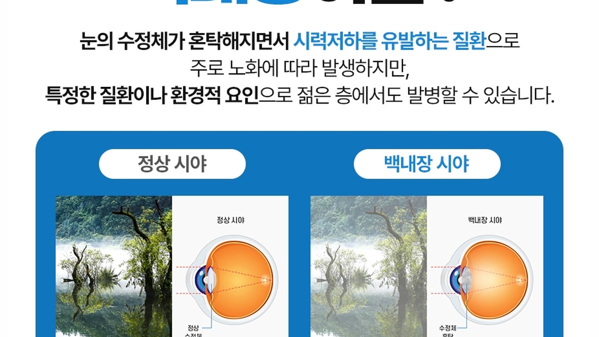 정상 시야와 백내장 시야를 나란히 비교한 도해, 안구 단면 그림 포함
