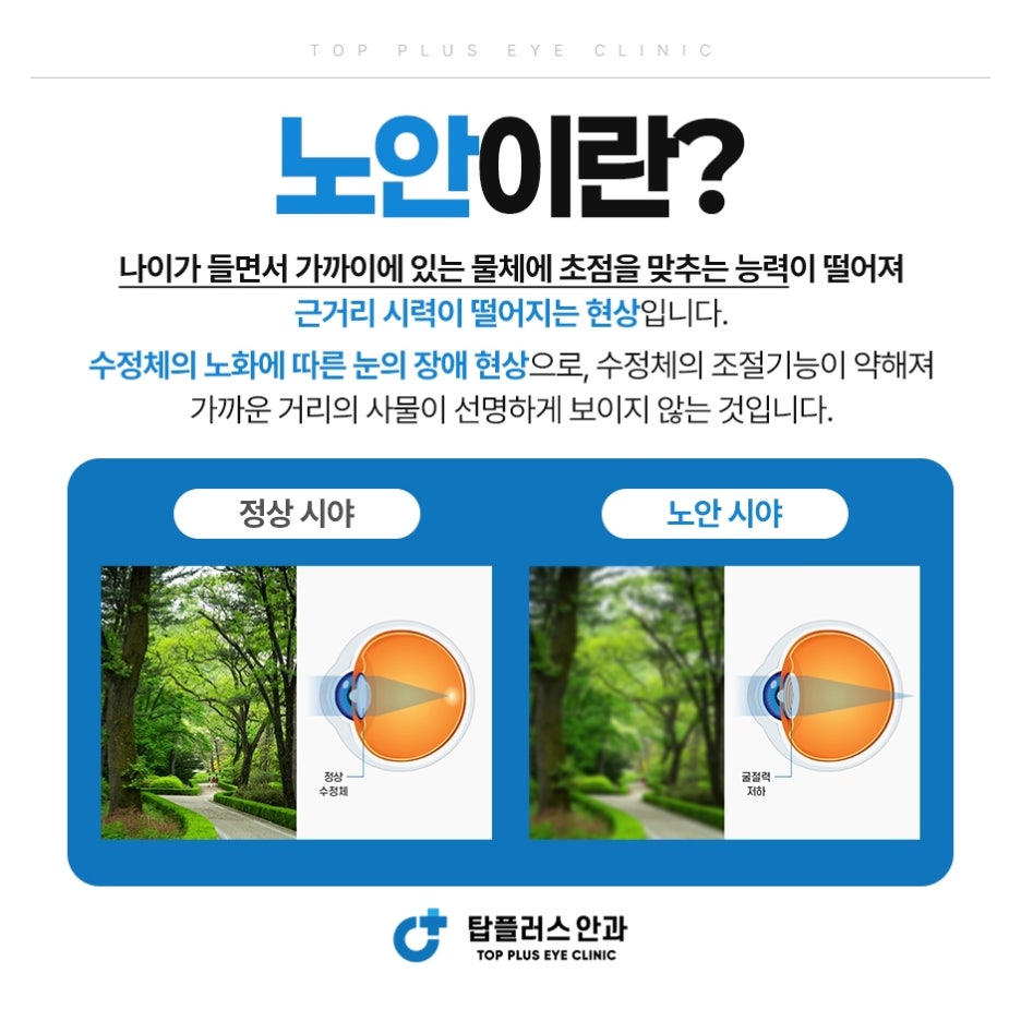 노안이란