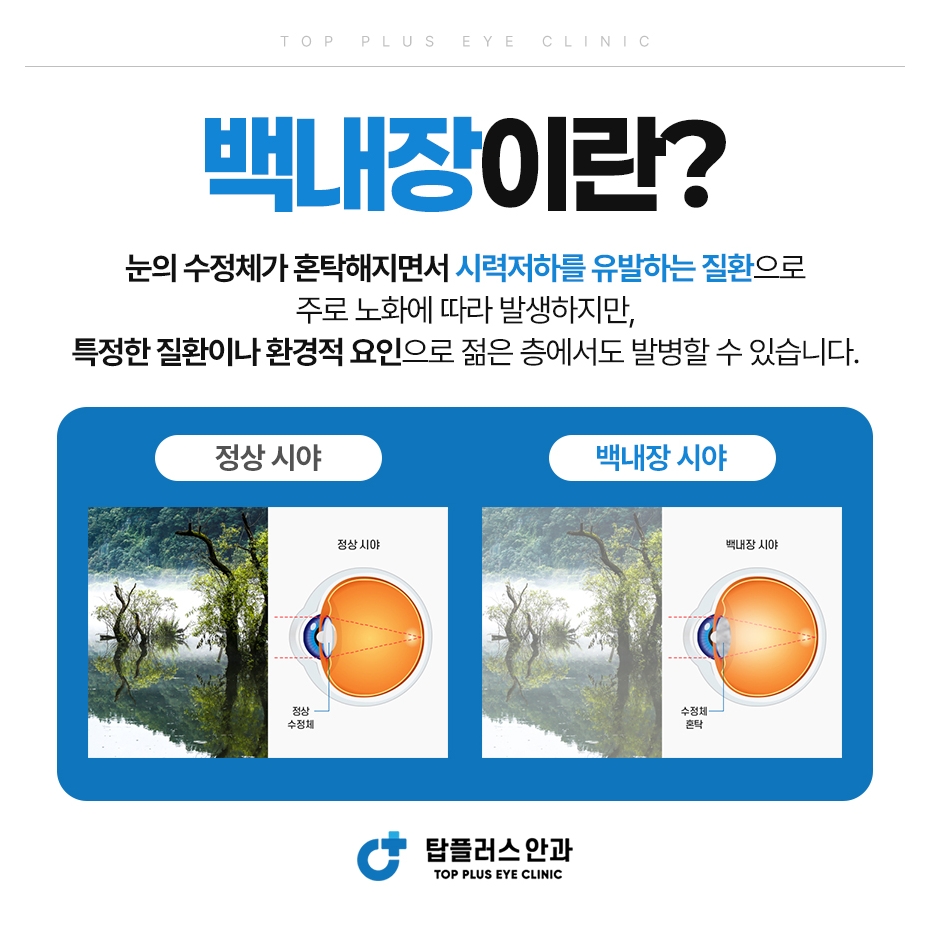 백내장이란
