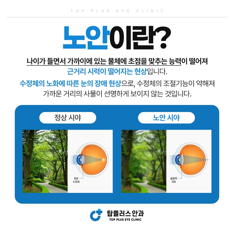 노안이란