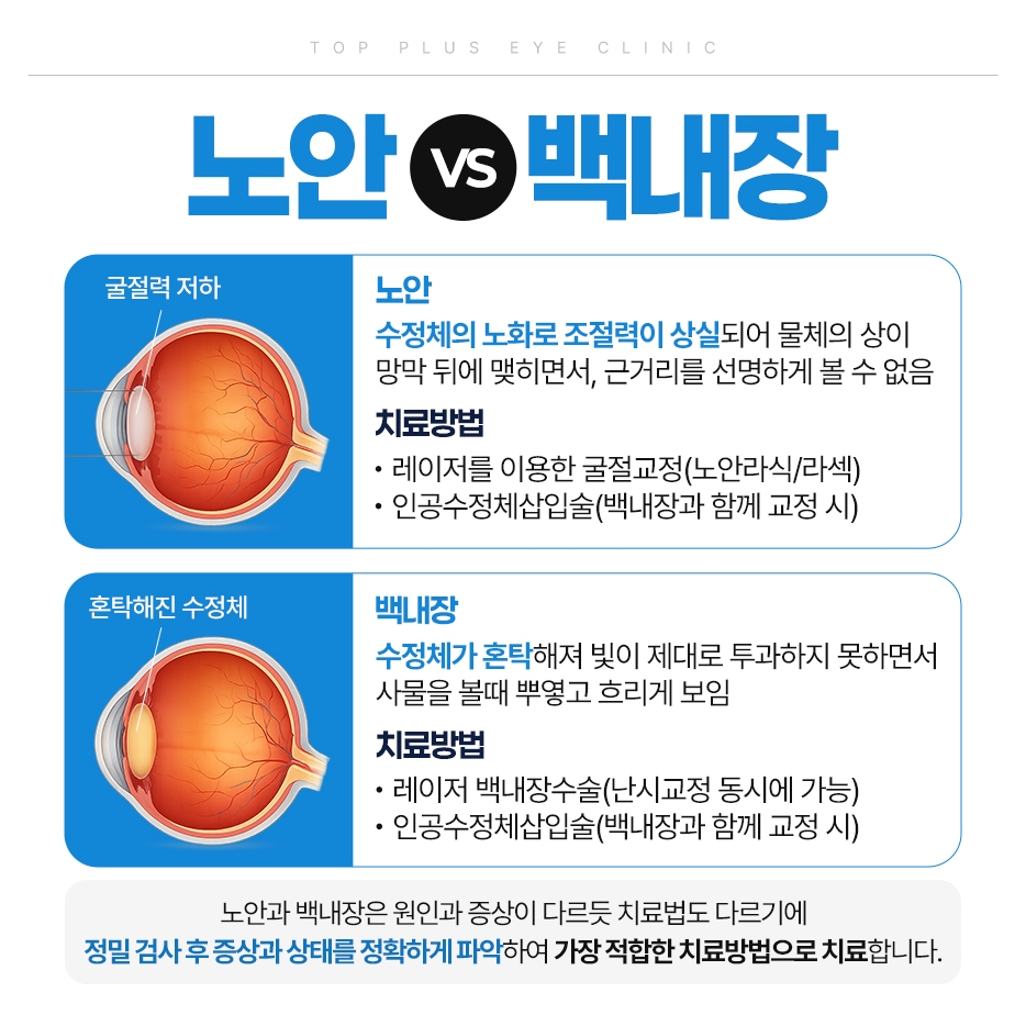 노안 백내장 비교