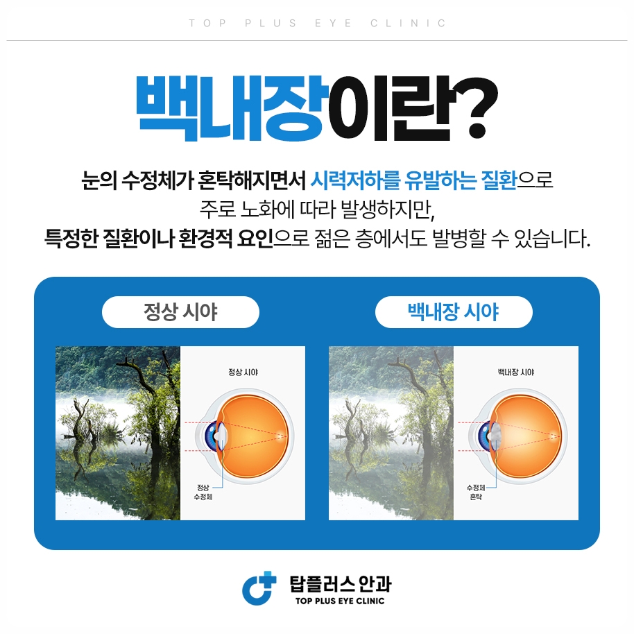 백내장 시야비교