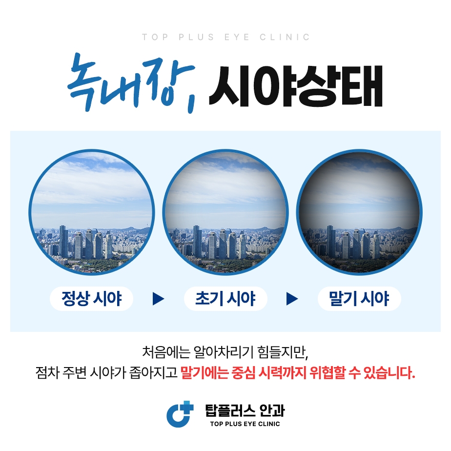 시야 변화 도해