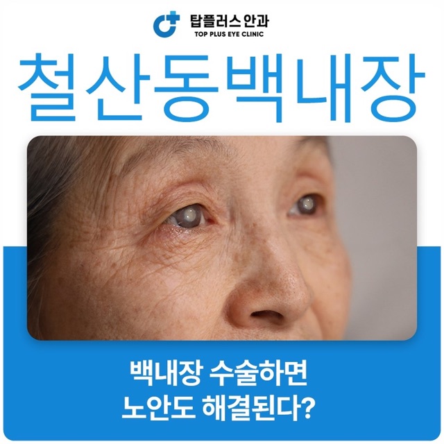 광명백내장 수술 후 회복 과정, 일상 복귀까지 순서와 주의 신호